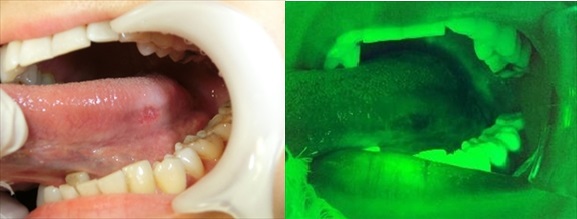 蛍光観察装置『ORALOOK』