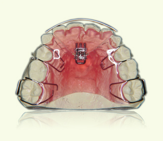 大人向け歯科矯正（床矯正）について｜歯科矯正・ホワイトニング・審美