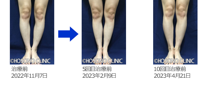 O脚・X脚治療プログラム-痛みの原因治療専門外来【細野クリニック
