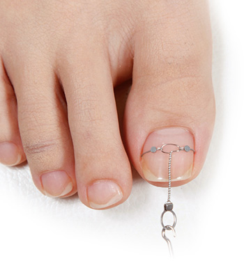 鍼灸・接骨院向け巻き爪矯正器具【インベントプラス】 | 株式会社