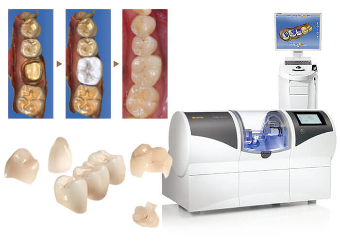 メタルフリー・セラミック治療は神戸市灘区うしじま歯科クリニックへ