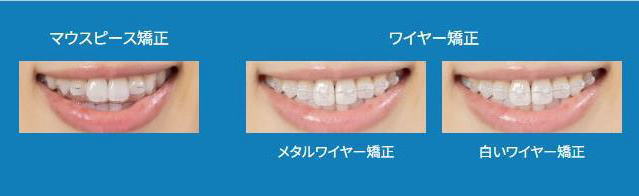 シュアスマイルアライナー（マウスピース）矯正 | 東林間で歯周病に