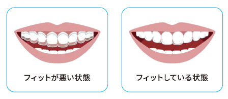 シュアスマイルアライナー（マウスピース）矯正 | 東林間で歯周病に