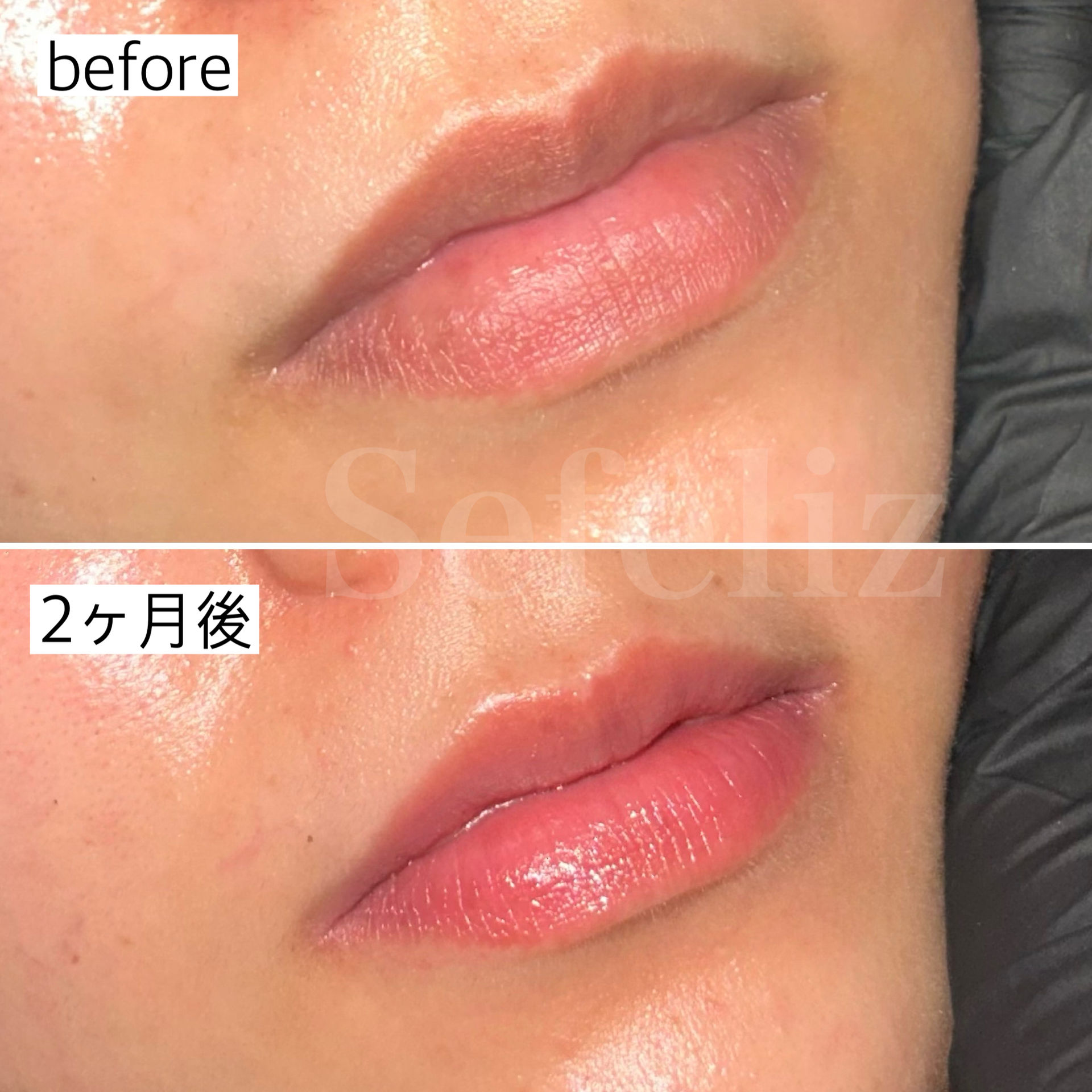 ローマピンクの効果がわからない人まとめ｜よくあるケースと正しい理解」