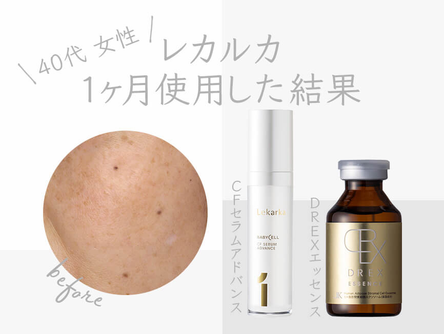 レカルカDREX ファビラスA-DR| ニキビ治療の実績多数｜セイコ