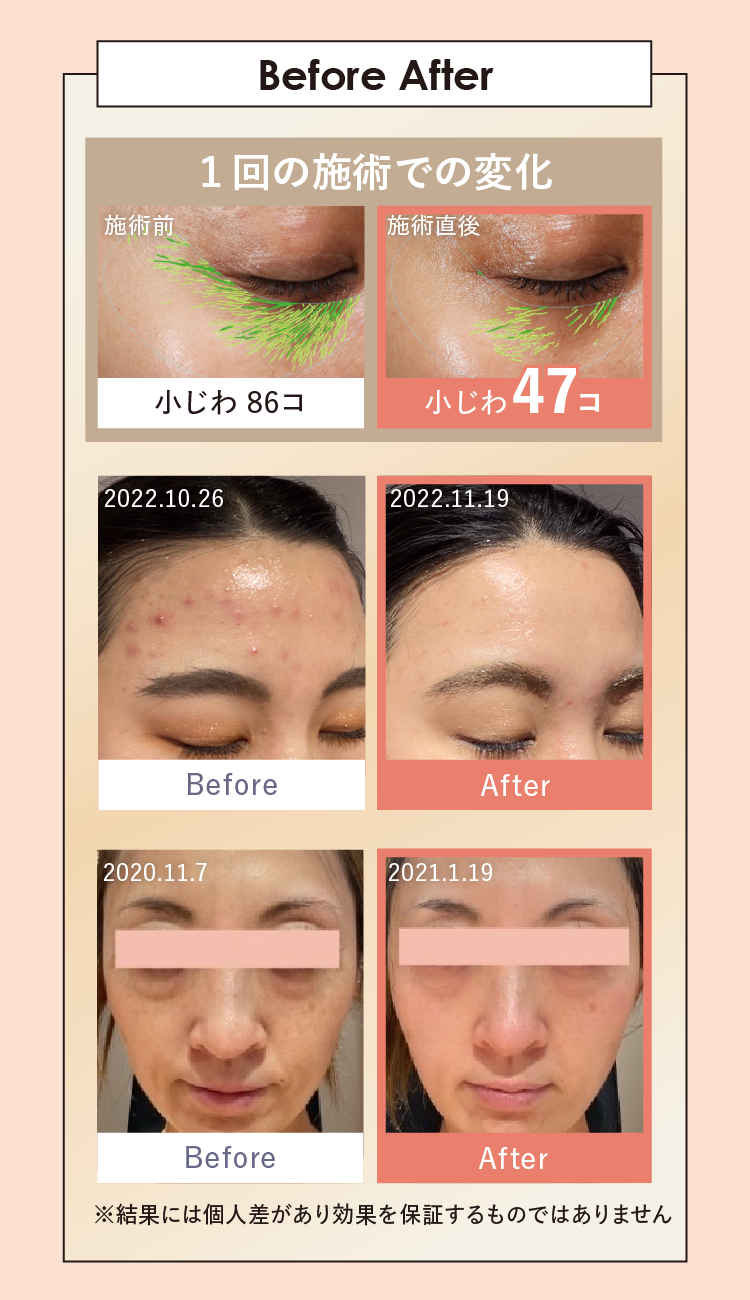 ボディアーキ ベビースキン プラン」誕生 | 【公式】定額制セルフ